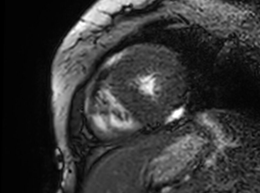 Cardiac amyloidosis (Radiopaedia 61600-69579 Short axis bSSFP 66).jpg