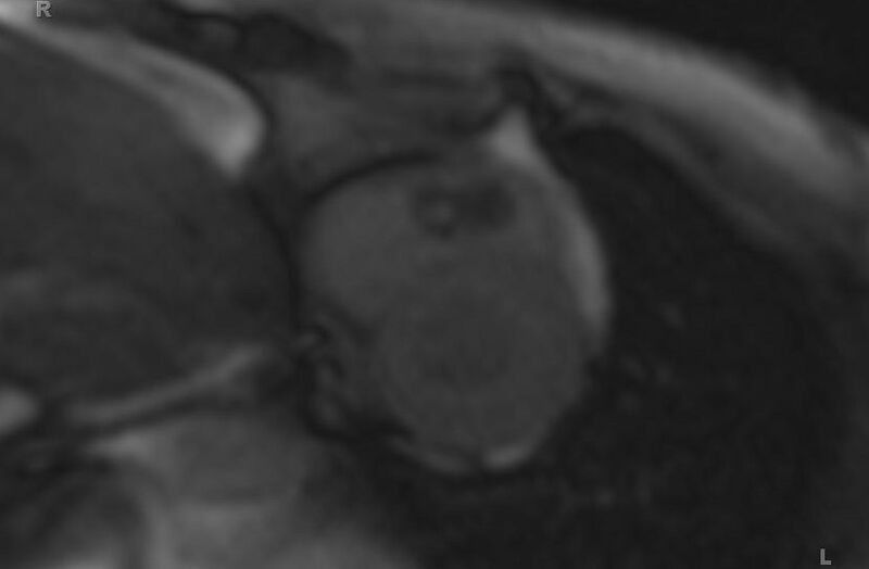 File:Cardiac hemangioma (Radiopaedia 31709-32631 Short axis 81).jpg