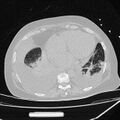 Cardiogenic pulmonary edema (Radiopaedia 29213-29609 Axial lung window 74).jpg
