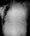 Catheter drainage of tuberculous pericarditis (Radiopaedia 6903-8033 Frontal 1).jpg