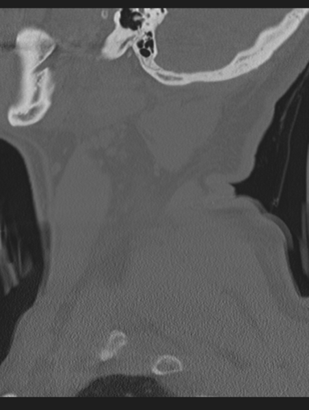 File:Cavernoma of cervical cord (Radiopaedia 50838-56346 Sagittal bone window 9).png