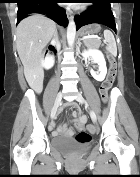 File:Cecum hernia through the foramen of Winslow (Radiopaedia 46634-51112 B 27).png