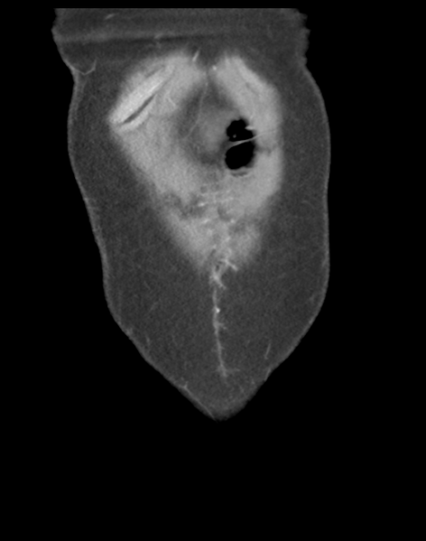File:Cecum hernia through the foramen of Winslow (Radiopaedia 46634-51112 B 6).png