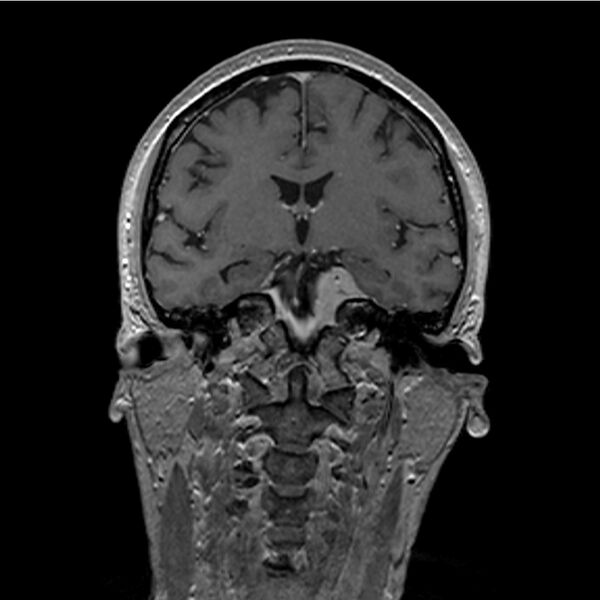 File:Central base of skull meningioma (Radiopaedia 53531-59549 Coronal T1 C+ 20).jpg