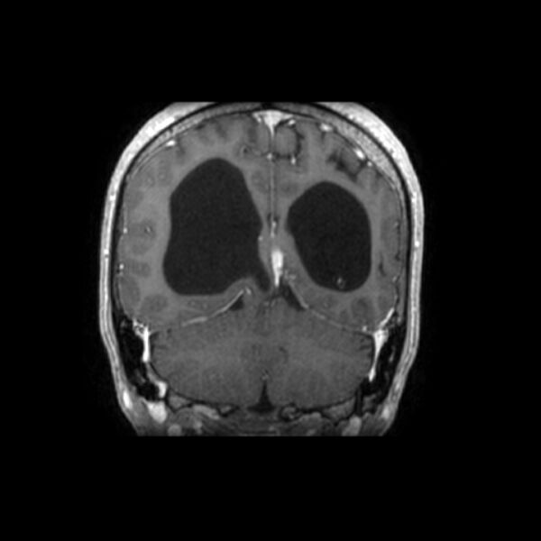 File:Central neurocytoma (Radiopaedia 67618-77021 Coronal T1 C+ 8).jpg