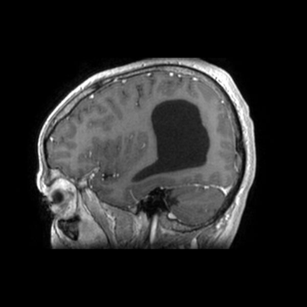 File:Central neurocytoma (Radiopaedia 67618-77021 Sagittal T1 C+ 7).jpg