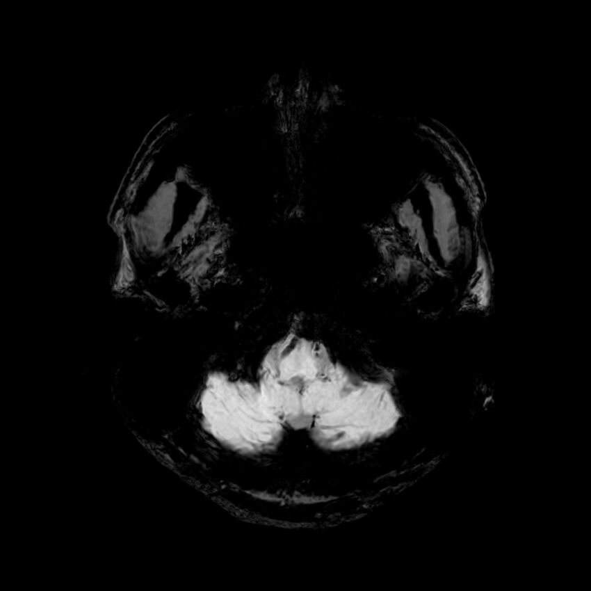 Central neurocytoma (Radiopaedia 79320-92380 Axial SWI 13).jpg