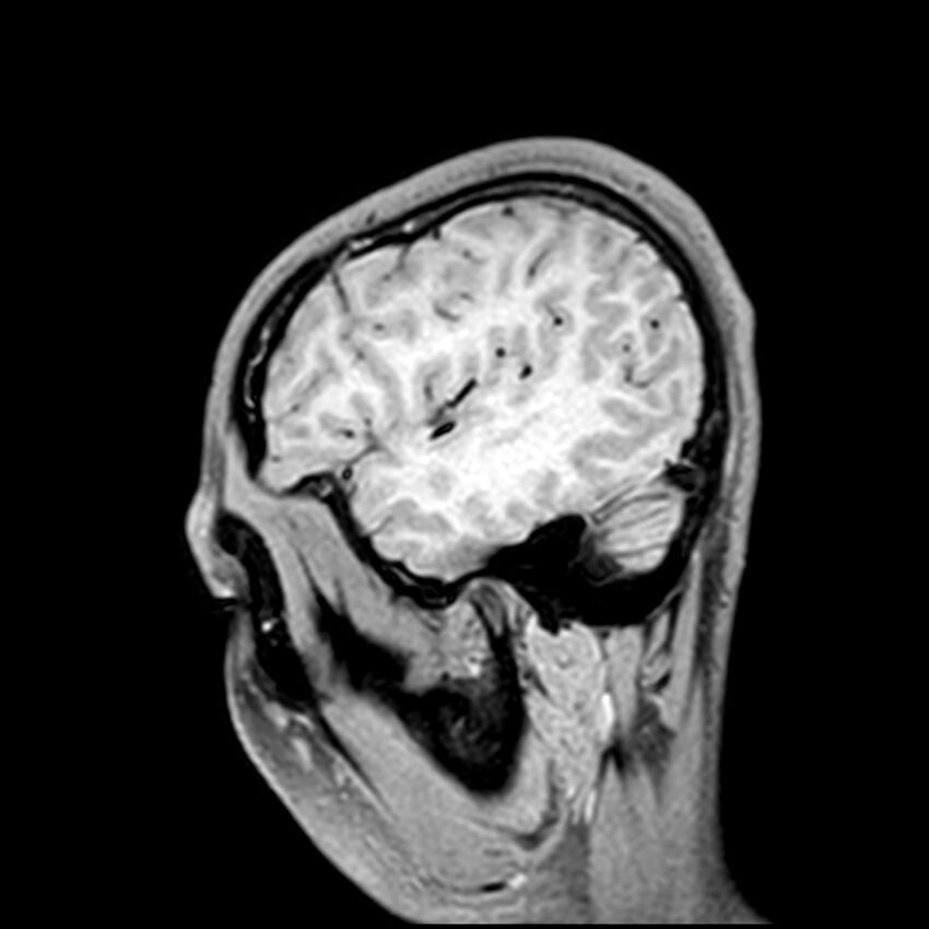 Central neurocytoma (Radiopaedia 79320-92380 Sagittal T1 53).jpg
