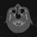 Cerebellar abscess secondary to mastoiditis (Radiopaedia 26284-26413 Axial bone window 3).jpg