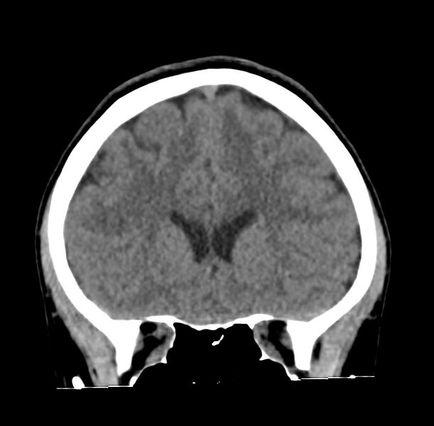 File:Cerebellar agenesis (Radiopaedia 30203-30817 Coronal non-contrast 7).jpg