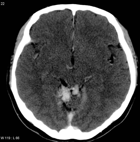 File:Cerebellar arteriovenous malformation (Radiopaedia 5220-36607 A 9).jpg