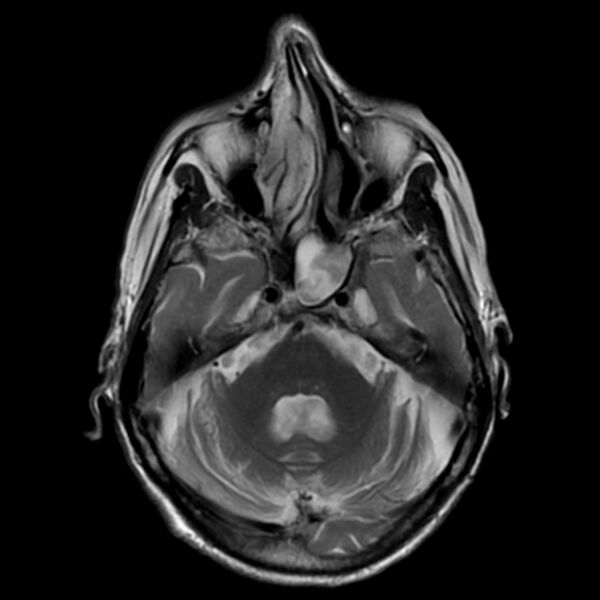 File:Cerebellar ataxia with neuropathy and vestibular areflexia syndrome (CANVAS) (Radiopaedia 74283-85159 Axial T2 7).jpg