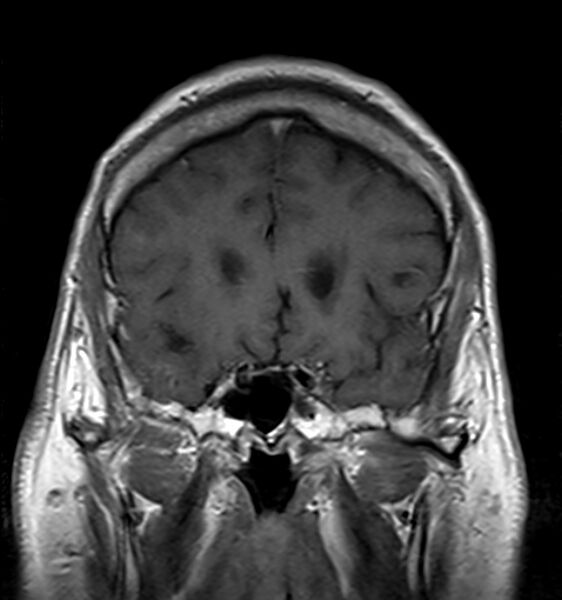 File:Cerebellopontine angle meningioma (Radiopaedia 24459-24764 Coronal T1 C+ 6).jpg