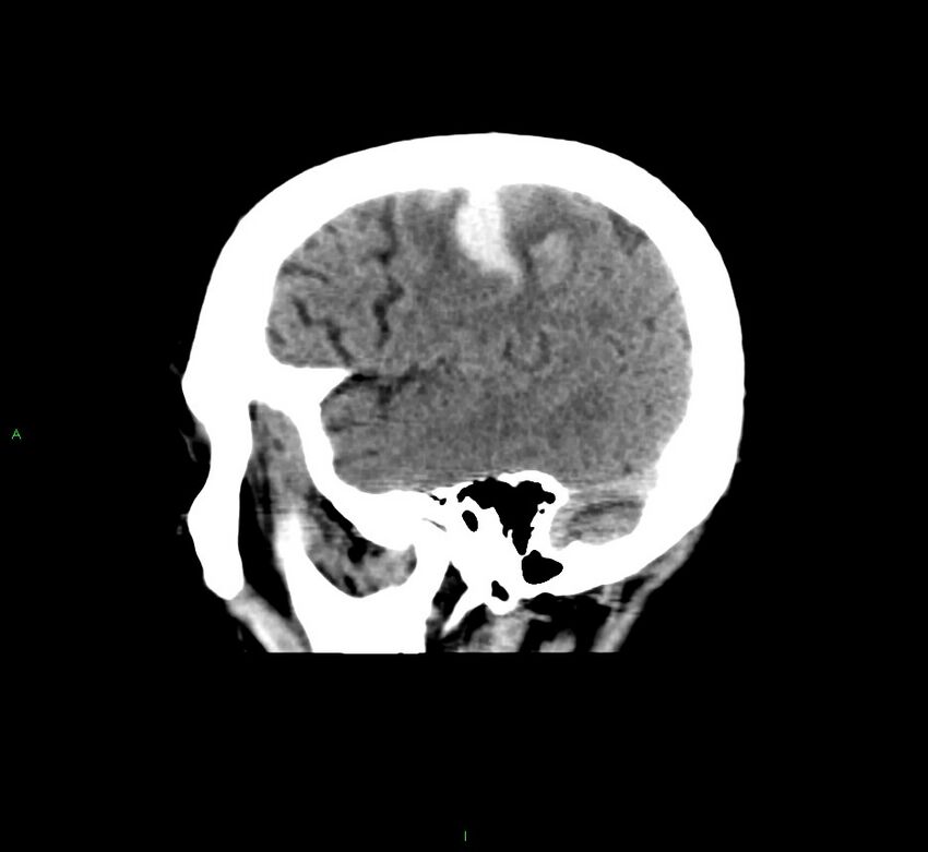 Cerebral amyloid angiopathy-associated lobar intracerebral hemorrhage (Radiopaedia 58376-65511 C 43).jpg