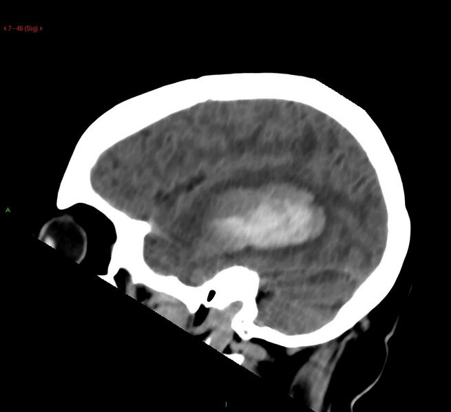 File:Cerebral amyloid angiopathy-associated lobar intracerebral hemorrhage (Radiopaedia 58378-65518 C 46).jpg