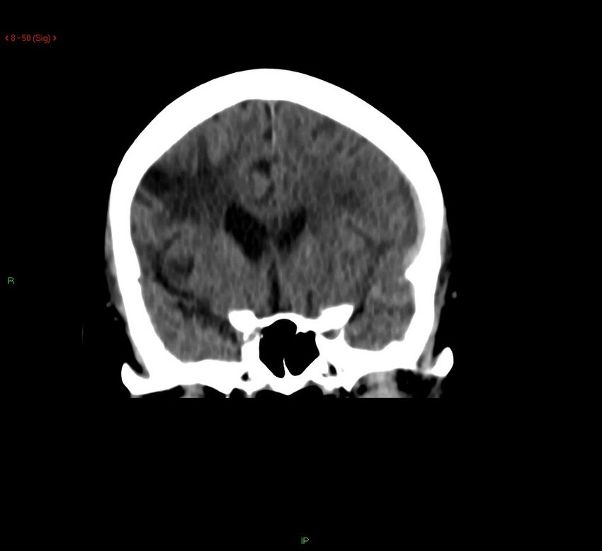 Cerebral amyloid angiopathy-associated lobar intracerebral hemorrhage (Radiopaedia 58378-65518 Coronal non-contrast 50).jpg