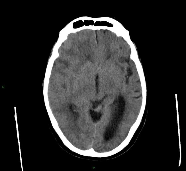 File:Cerebral amyloid angiopathy-associated lobar intracerebral hemorrhage (Radiopaedia 58560-65723 Axial non-contrast 31).jpg