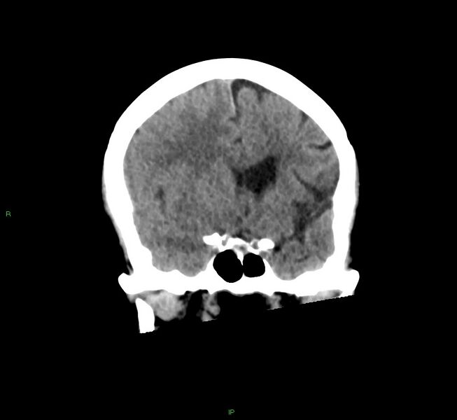 File:Cerebral amyloid angiopathy-associated lobar intracerebral hemorrhage (Radiopaedia 58563-65727 Coronal non-contrast 43).jpg