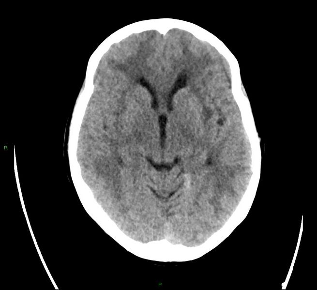 File:Cerebral amyloid angiopathy-associated lobar intracerebral hemorrhage (Radiopaedia 58566-65731 Axial non-contrast 11).jpg