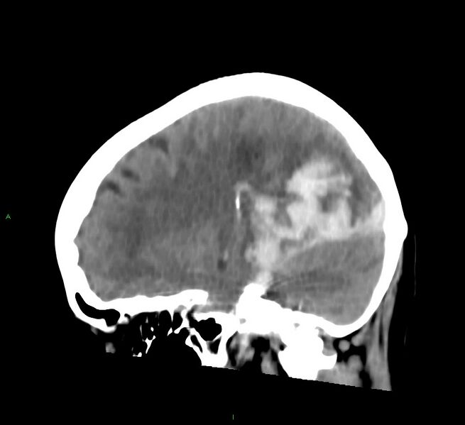 File:Cerebral amyloid angiopathy-associated lobar intracerebral hemorrhage (Radiopaedia 58754-65975 C 31).jpg