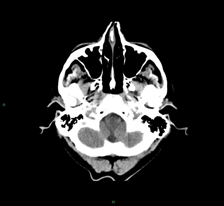 Cerebral amyloid angiopathy-associated lobar intracerebral hemorrhage (Radiopaedia 58756-65977 Axial non-contrast 46).jpg