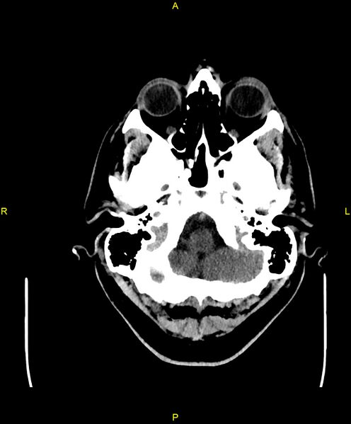 File:Cerebral autosomal dominant arteriopathy with subcortical infarcts and leukoencephalopathy (CADASIL) (Radiopaedia 86108-102051 Axial non-contrast 13).jpg