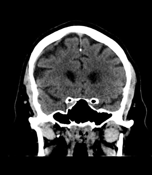File:Cerebral dural venous sinus thrombosis (Radiopaedia 86514-102575 Coronal non-contrast 15).jpg