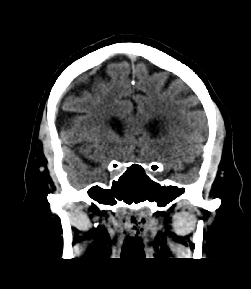 Cerebral dural venous sinus thrombosis (Radiopaedia 86514-102575 Coronal non-contrast 15).jpg