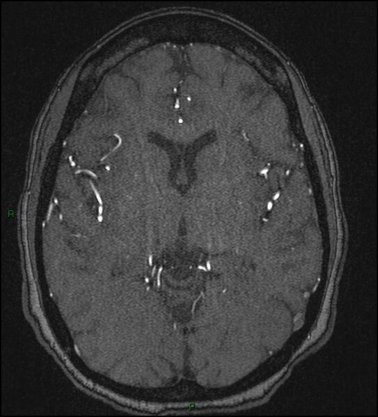 File:Cerebral fat embolism (Radiopaedia 35022-36525 Axial TOF 102).jpg