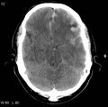 Cerebral hemorrhagic contusion with subdural and subarachnoid hemorrhage (Radiopaedia 10680-11146 Axial non-contrast 9).jpg