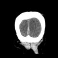 Cerebral hemorrhagic contusions (Radiopaedia 23145-23188 Coronal non-contrast 40).jpg