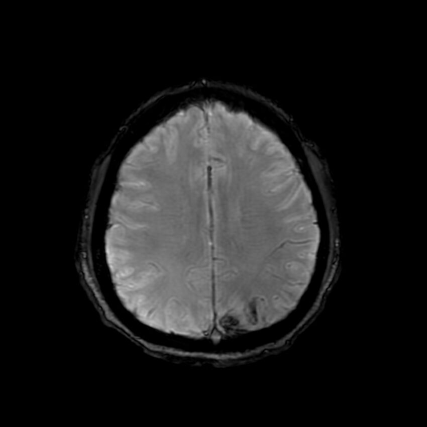 Cerebral paragonimiasis (Radiopaedia 73473-84238 Axial SWI 48).jpg