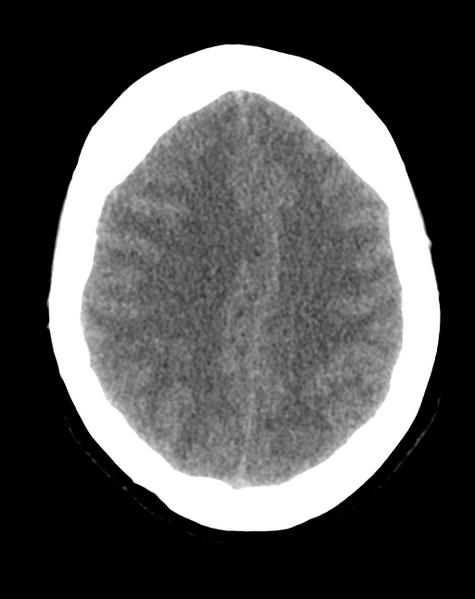 File:Cerebral venous infarct related to dural venous sinus thromboses (Radiopaedia 35292-36803 AXIAL THICK 20).png