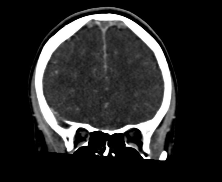 File:Cerebral venous sinus thrombosis (Radiopaedia 59224-66646 Coronal C+ delayed 21).jpg