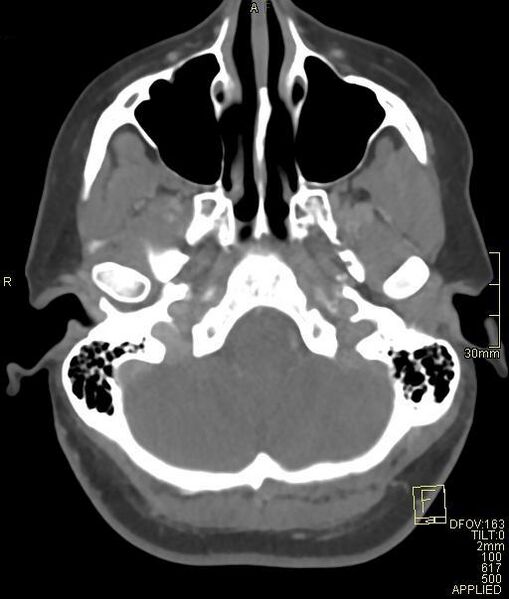 File:Cerebral venous sinus thrombosis (Radiopaedia 91329-108965 Axial venogram 16).jpg