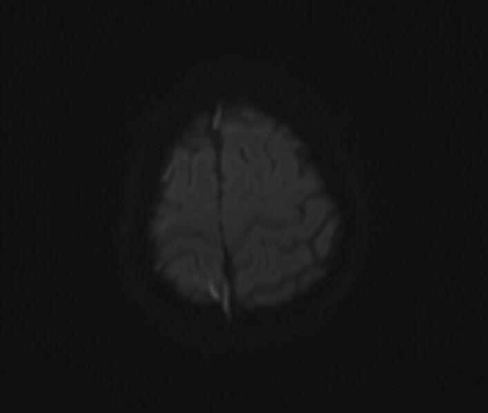 File:Cerebral venous thrombosis (Radiopaedia 71207-81504 Axial DWI 17).jpg
