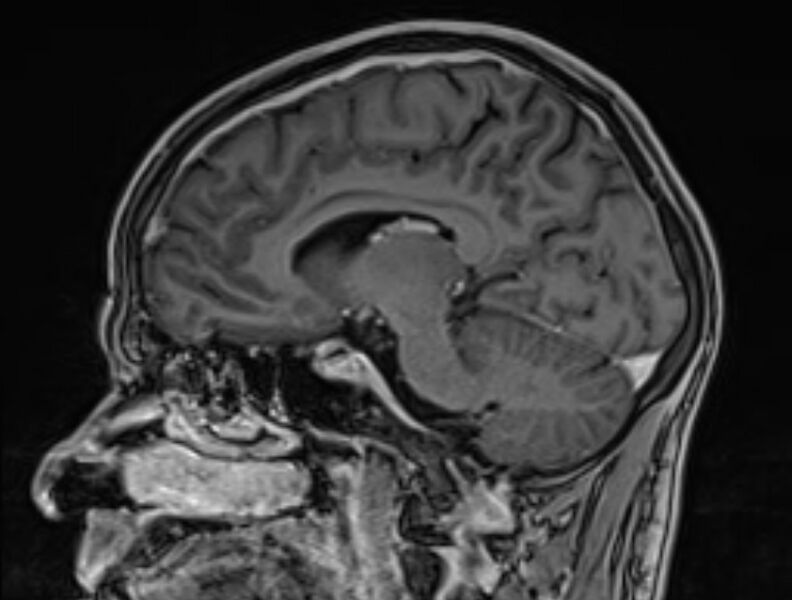 File:Cerebral venous thrombosis (Radiopaedia 71207-81504 Sagittal T1 C+ 35).jpg