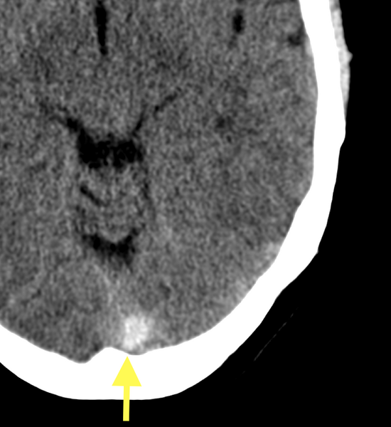 File:Cerebral venous thrombosis - CT only (Radiopaedia 41031-43779 B 1).png