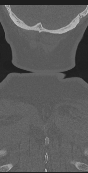 File:Cervical canal stenosis due to ossification of the posterior longitudinal ligament (Radiopaedia 47260-51823 Coronal bone window 71).png
