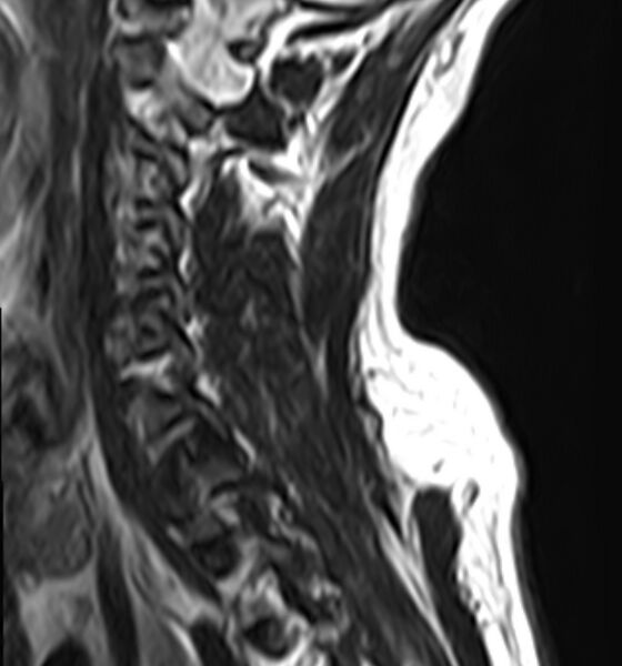 File:Cervical compressive myelopathy (Radiopaedia 71956-82411 C 10).jpg