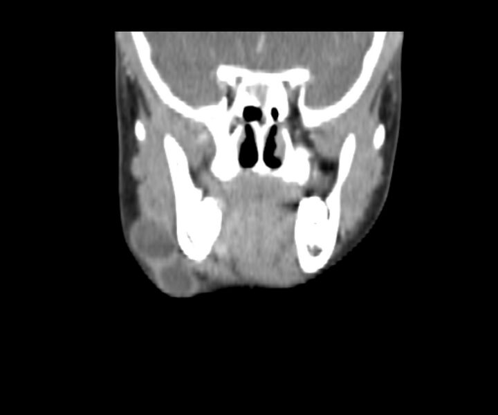 File:Cervical cystic lymphangioma (Radiopaedia 63655-72332 Coronal + contrast 14).jpg