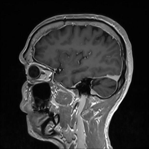 File:Cervical dural CSF leak on MRI and CT treated by blood patch (Radiopaedia 49748-54995 G 22).jpg