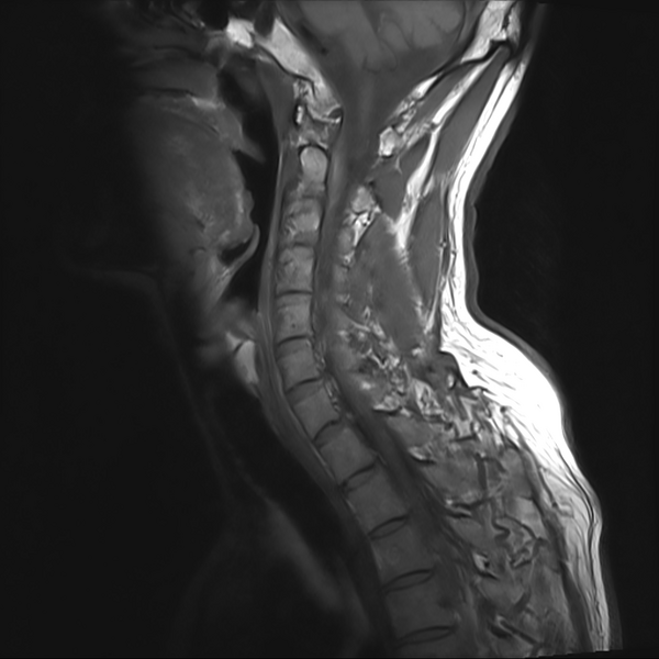 File:Cervical dural CSF leak on MRI and CT treated by blood patch (Radiopaedia 49748-54995 Sagittal T1 7).png