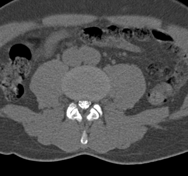 File:Cervical dural CSF leak on MRI and CT treated by blood patch (Radiopaedia 49748-54996 B 106).png