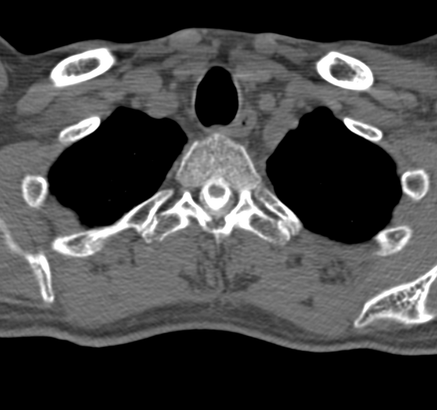 File:Cervical dural CSF leak on MRI and CT treated by blood patch (Radiopaedia 49748-54996 B 43).png