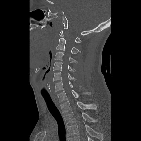 File:Cervical facet fracture and anterior discoligamentous injury (Radiopaedia 32139-33083 Sagittal bone window 16).jpg
