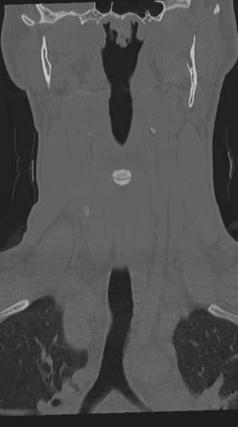 File:Cervical intercalary bone (Radiopaedia 35211-36748 Coronal bone window 23).png