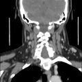 Cervical lymphadenopathy- cause unknown (Radiopaedia 22420-22457 C 26).jpg