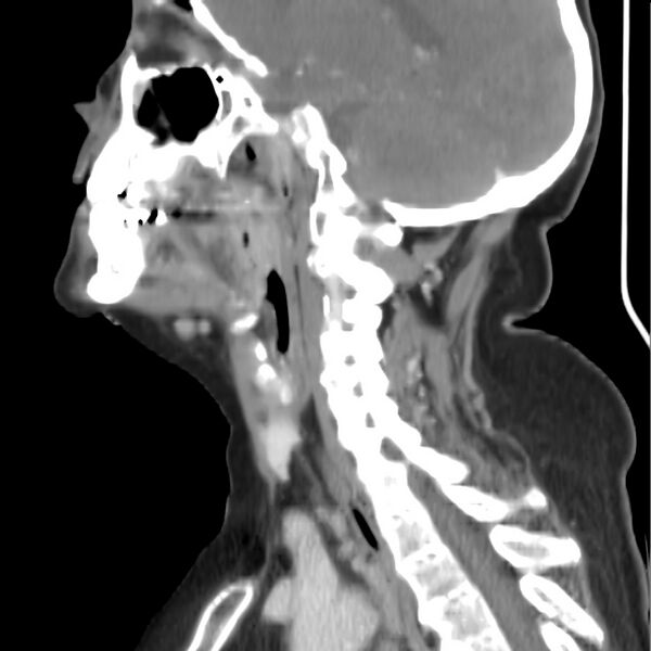 File:Cervical lymphadenopathy- cause unknown (Radiopaedia 22420-22457 D 23).jpg