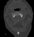 Cervical spine ACDF loosening (Radiopaedia 48998-54070 Axial bone window 19).png
